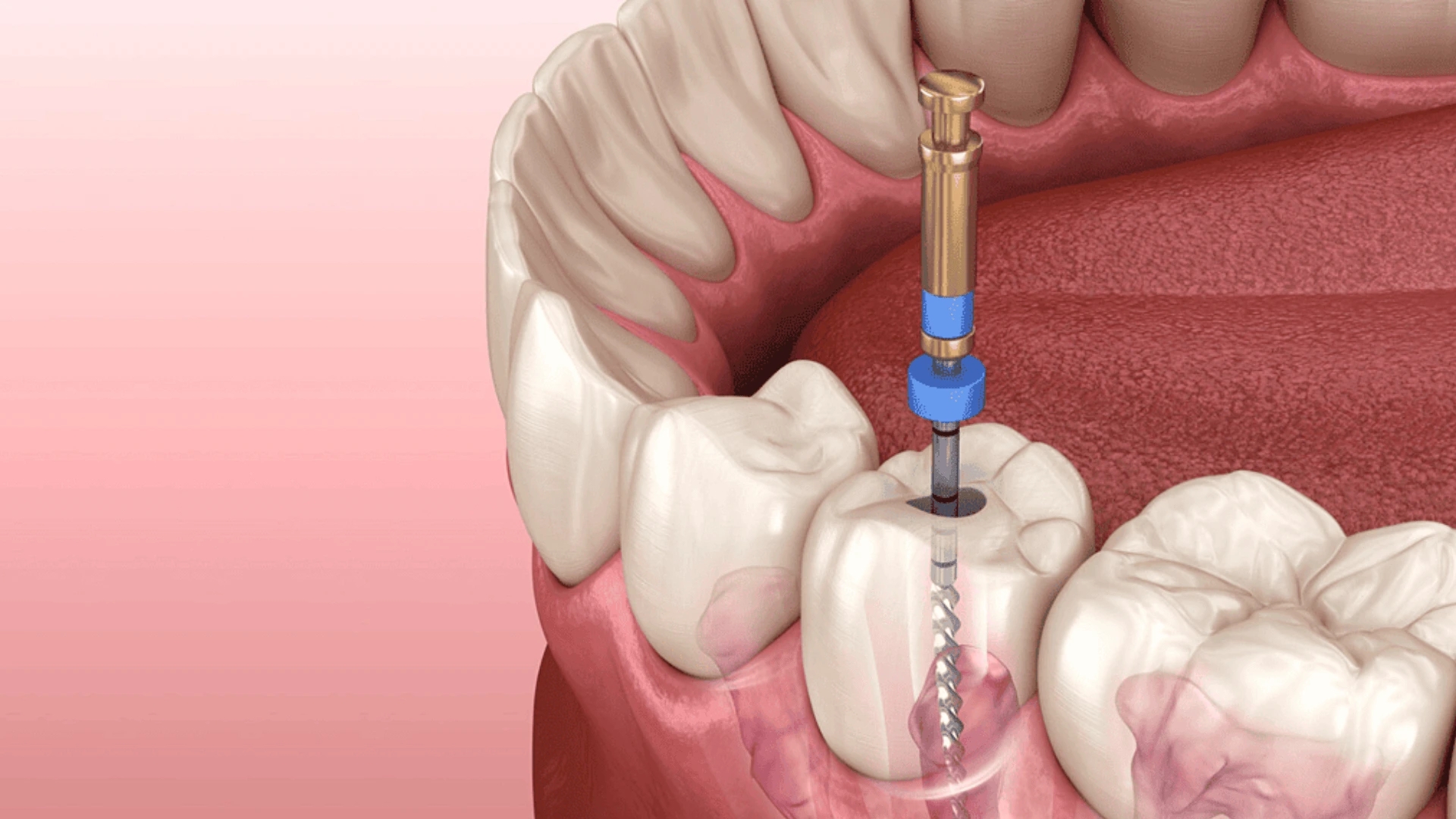 Post-Root Canal Care – A Comprehensive Guide for Fast Recovery