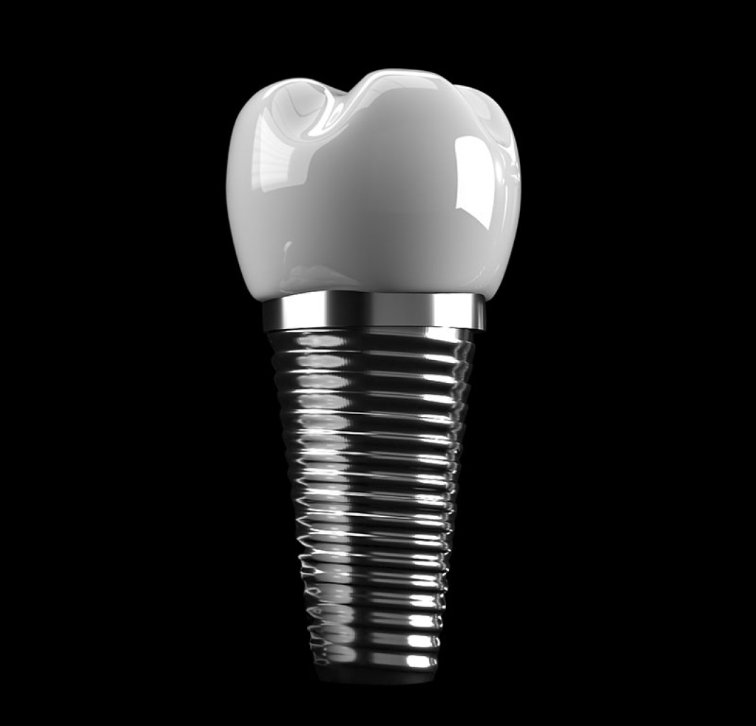 Dental Implant
