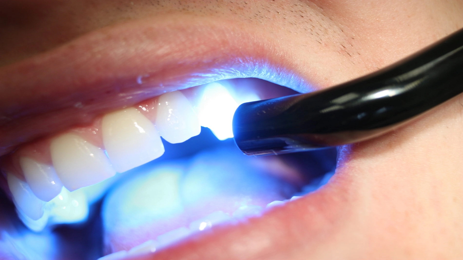 Bad Breath After Dental Composite; Causes and Solutions