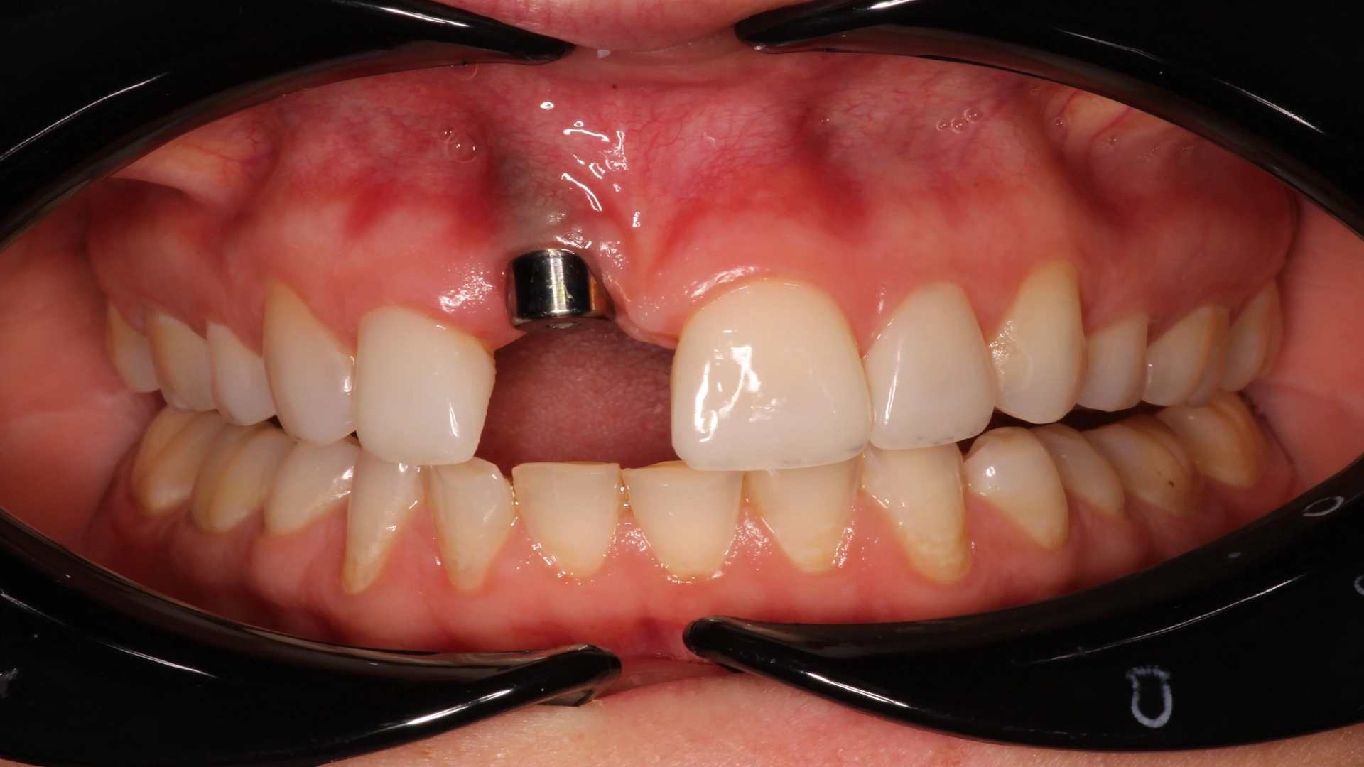 Everything About Dental Implant Rejection Symptoms: From Prevention to Treatment