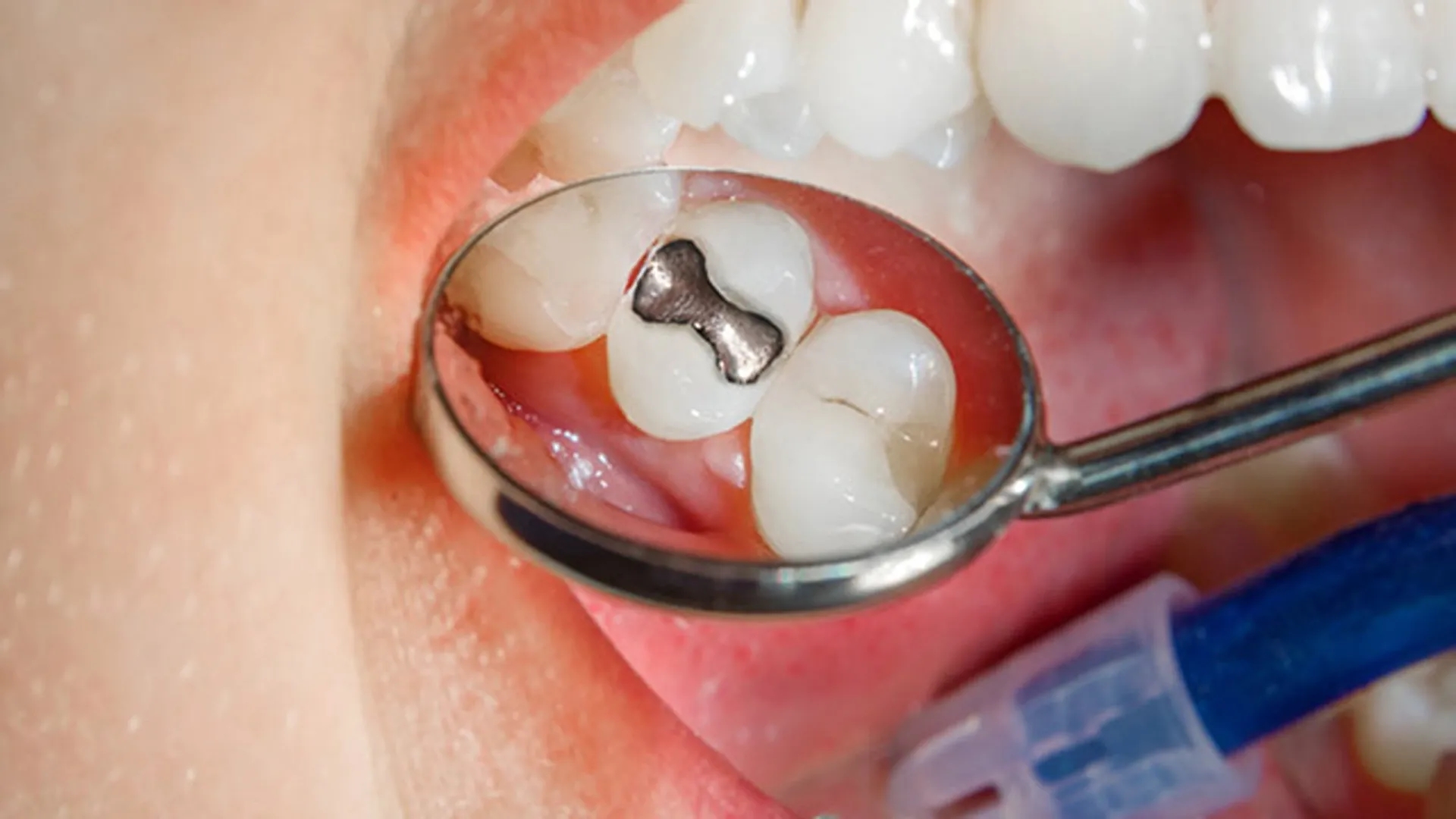 Important Post-Filling Care: Increasing the Longevity of a Filled Tooth