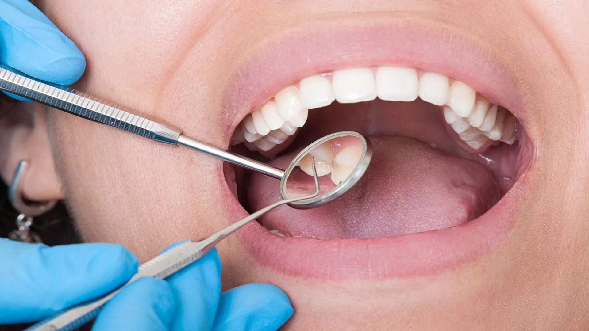 What Causes Tooth Pain? Best Treatments for Tooth Pain
