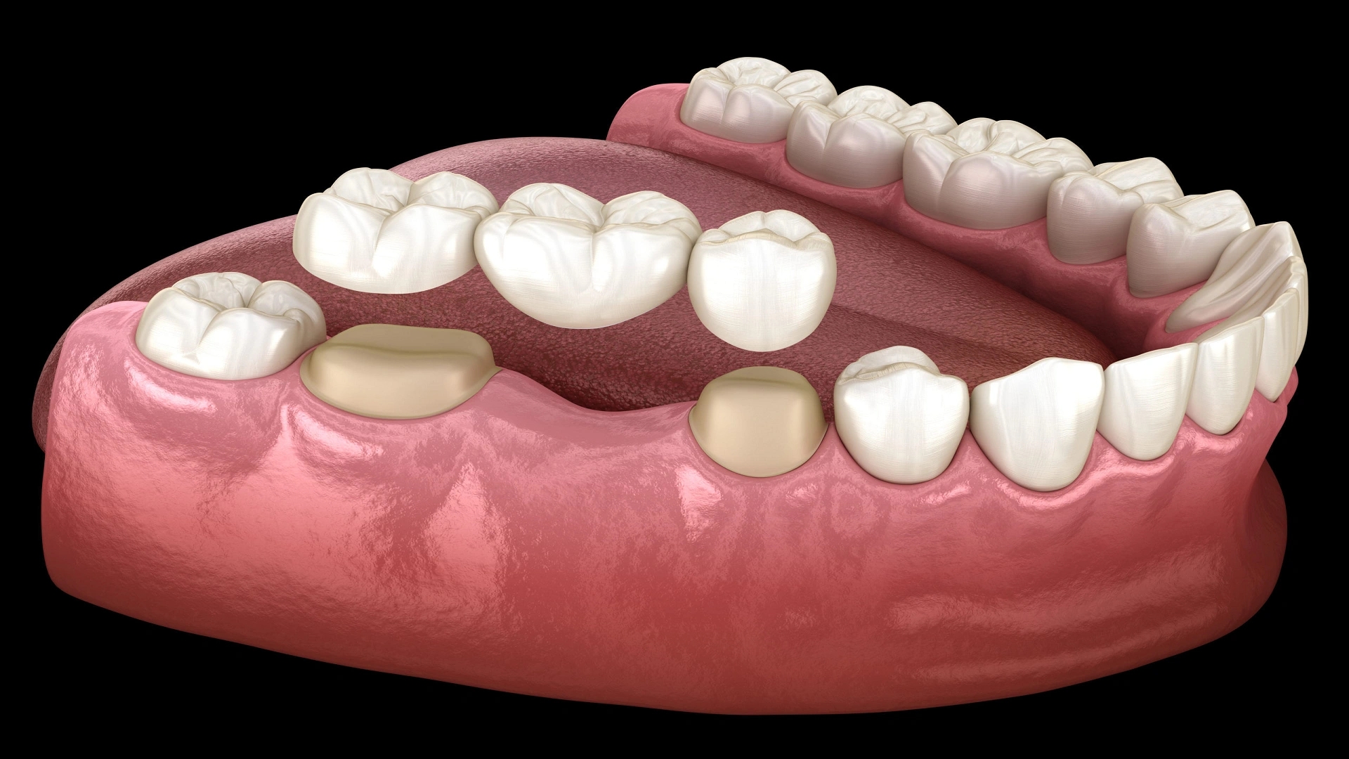 A Broken Tooth Crown: The Best Option for Restoring a Damaged Tooth