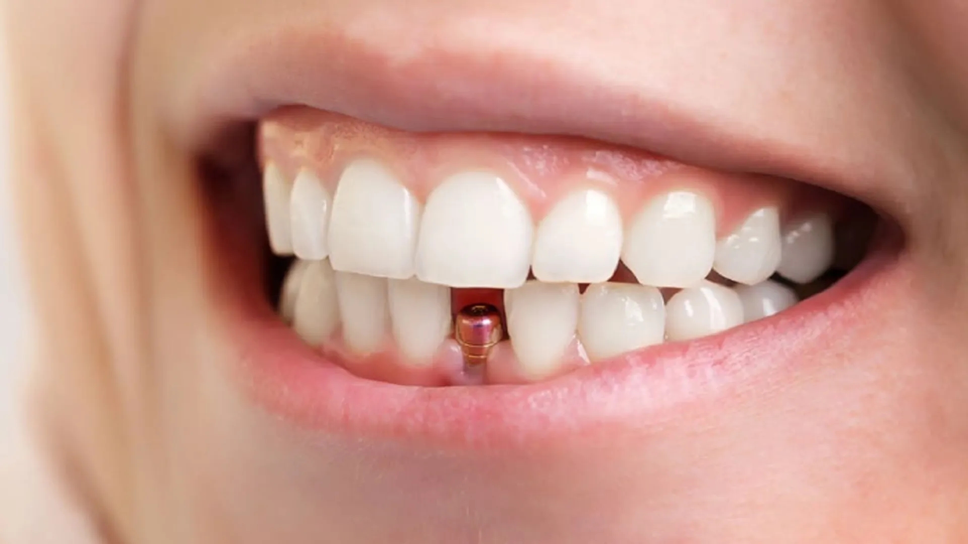 Post-Implant Care: Accelerating Healing and Gum Inflammation After Dental Implants