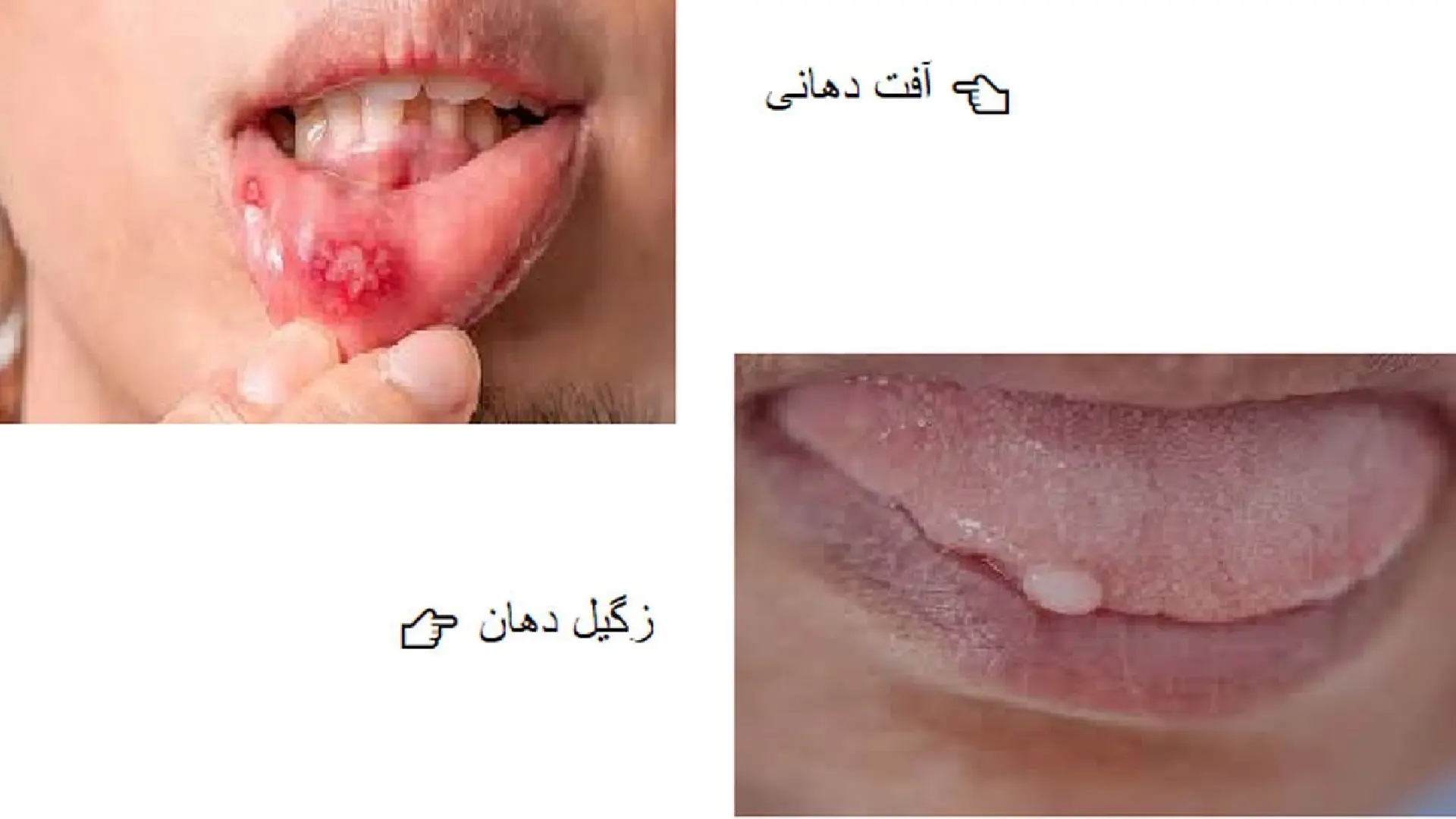 Introducing the Difference Between Mouth Ulcers and Oral Warts: A Complete Review of Symptoms, Causes, and Treatment Methods