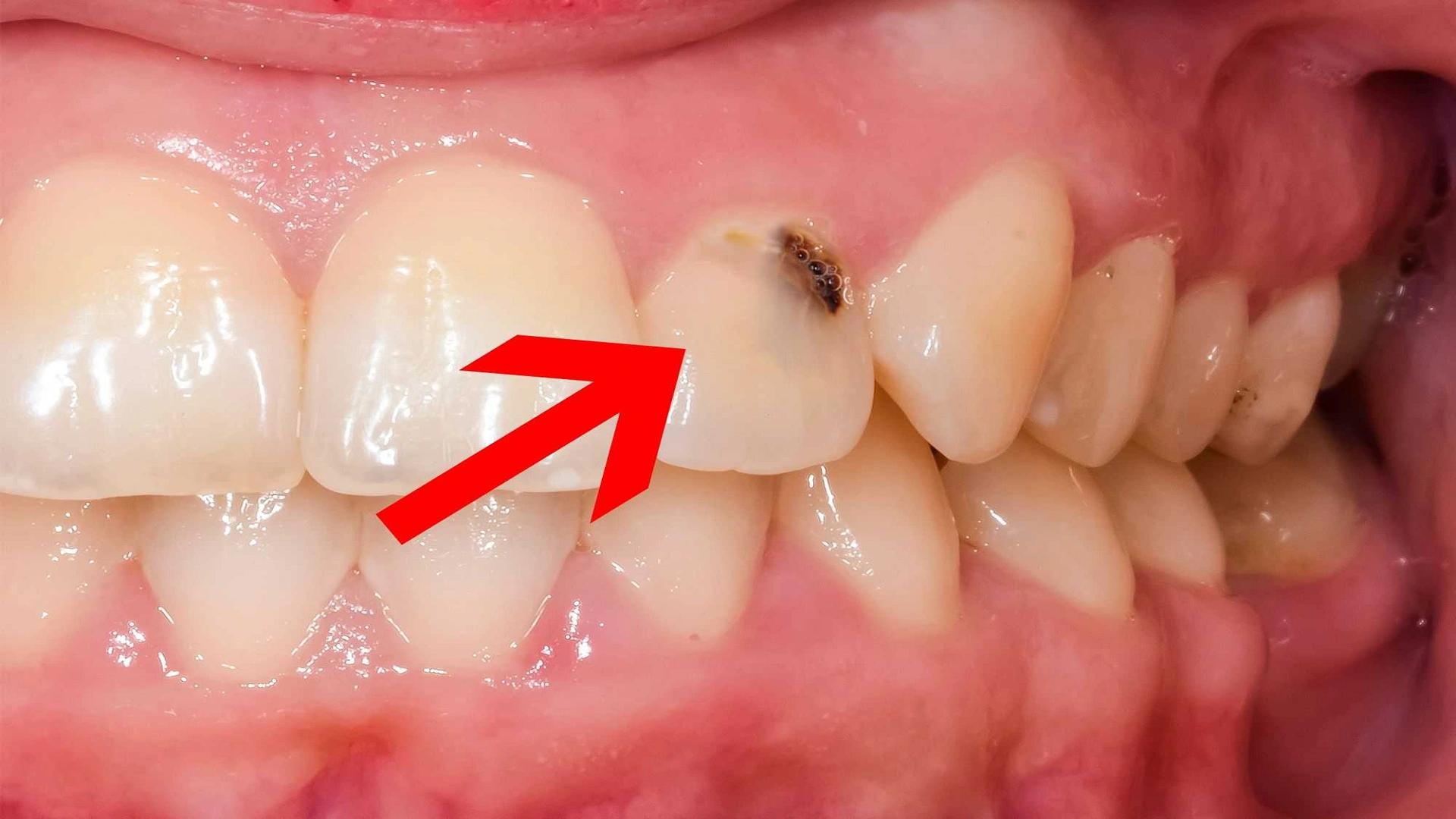 Everything About Tooth Decay: Causes, Prevention, and Treatment