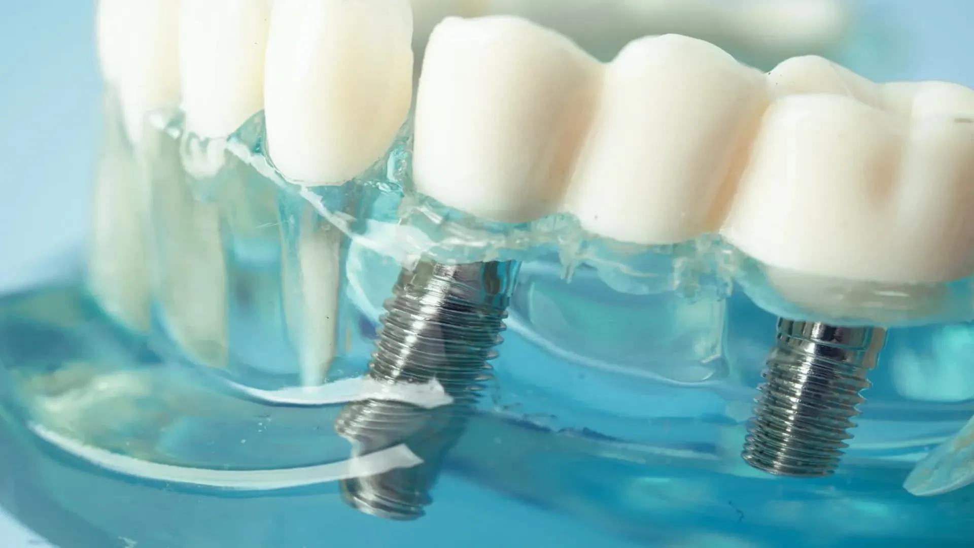 How long after tooth extraction should you get a dental implant?