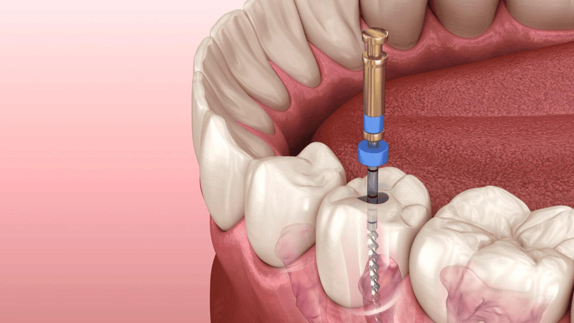 Post-Root Canal Care – A Comprehensive Guide for Fast Recovery