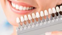 How Much Tooth Shaving Is Done for Veneers? + Procedure