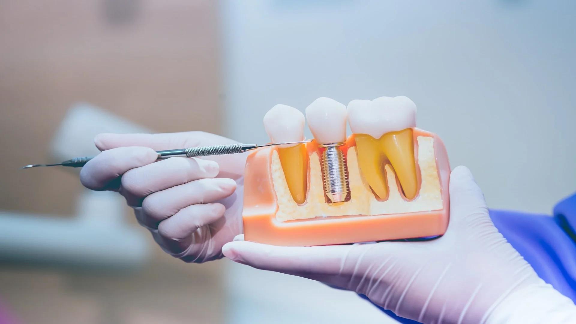 How Many Years After Tooth Extraction Can You Get an Implant? A Complete Review of Implants After Several Years of Tooth Extraction