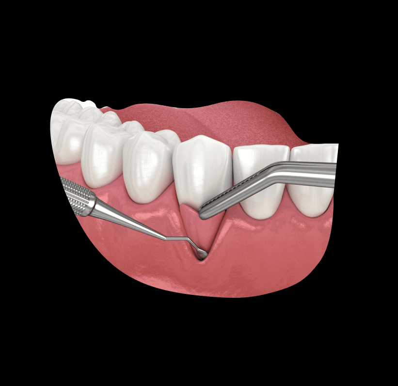 Gum surgery