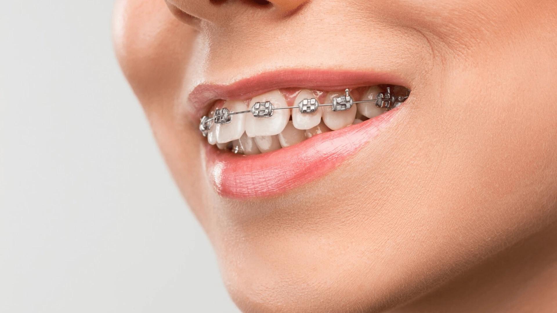 بهترین سن برای ارتودنسی چه زمانی است؟
