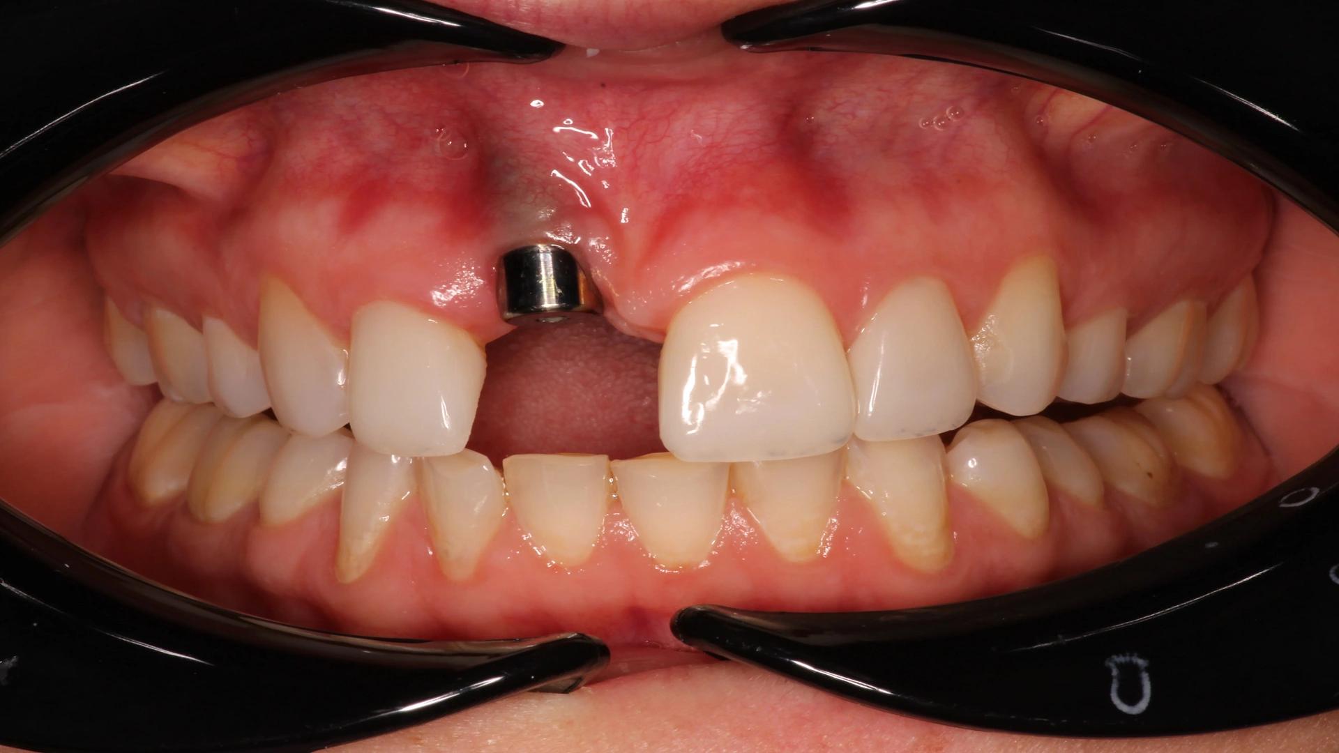 Everything About Dental Implant Rejection Symptoms: From Prevention to Treatment