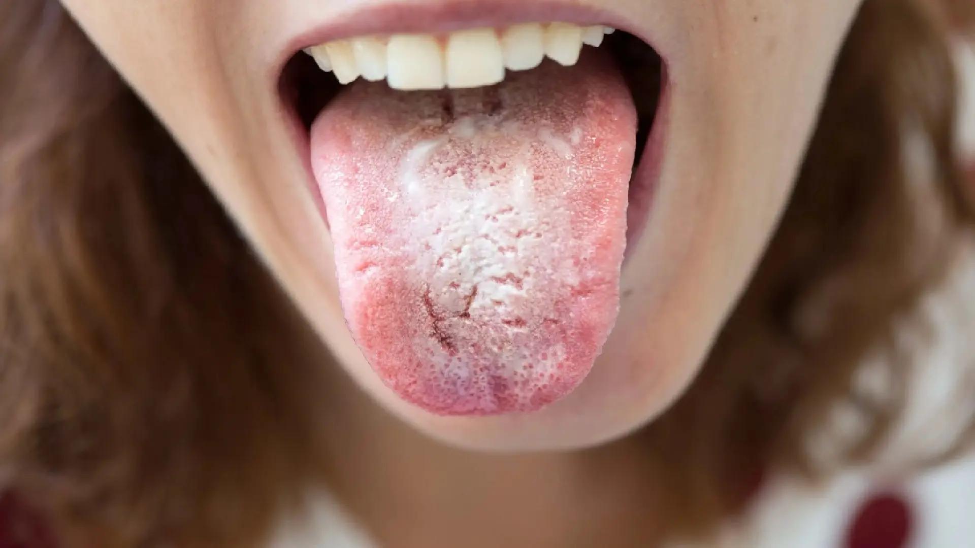 Oral Thrush: Complete Guide to This Condition in Infants and Adults + Treatment Options
