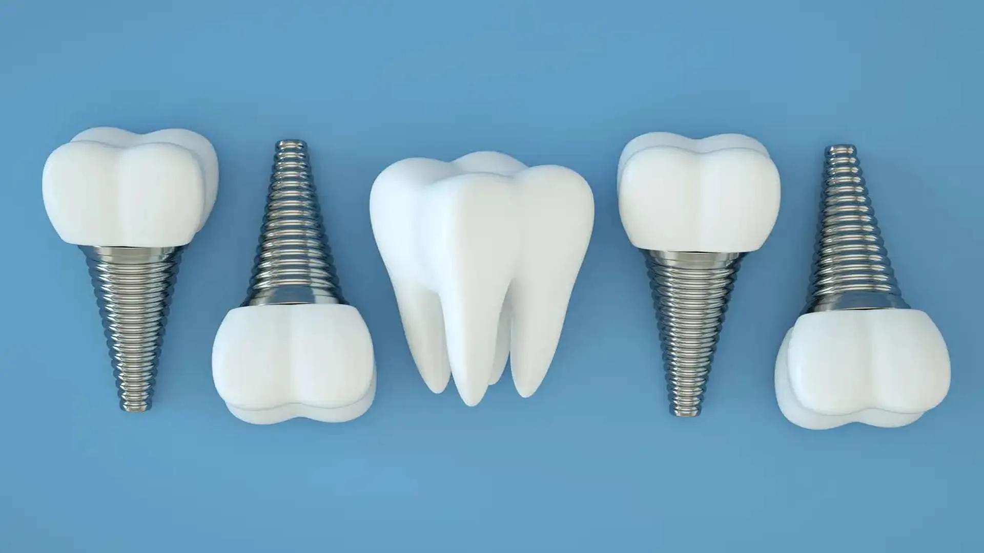 اگر پیج ایمپلنت بیفتد چه کنیم؟ راهنمای کامل برای درمان ایمپلنت 