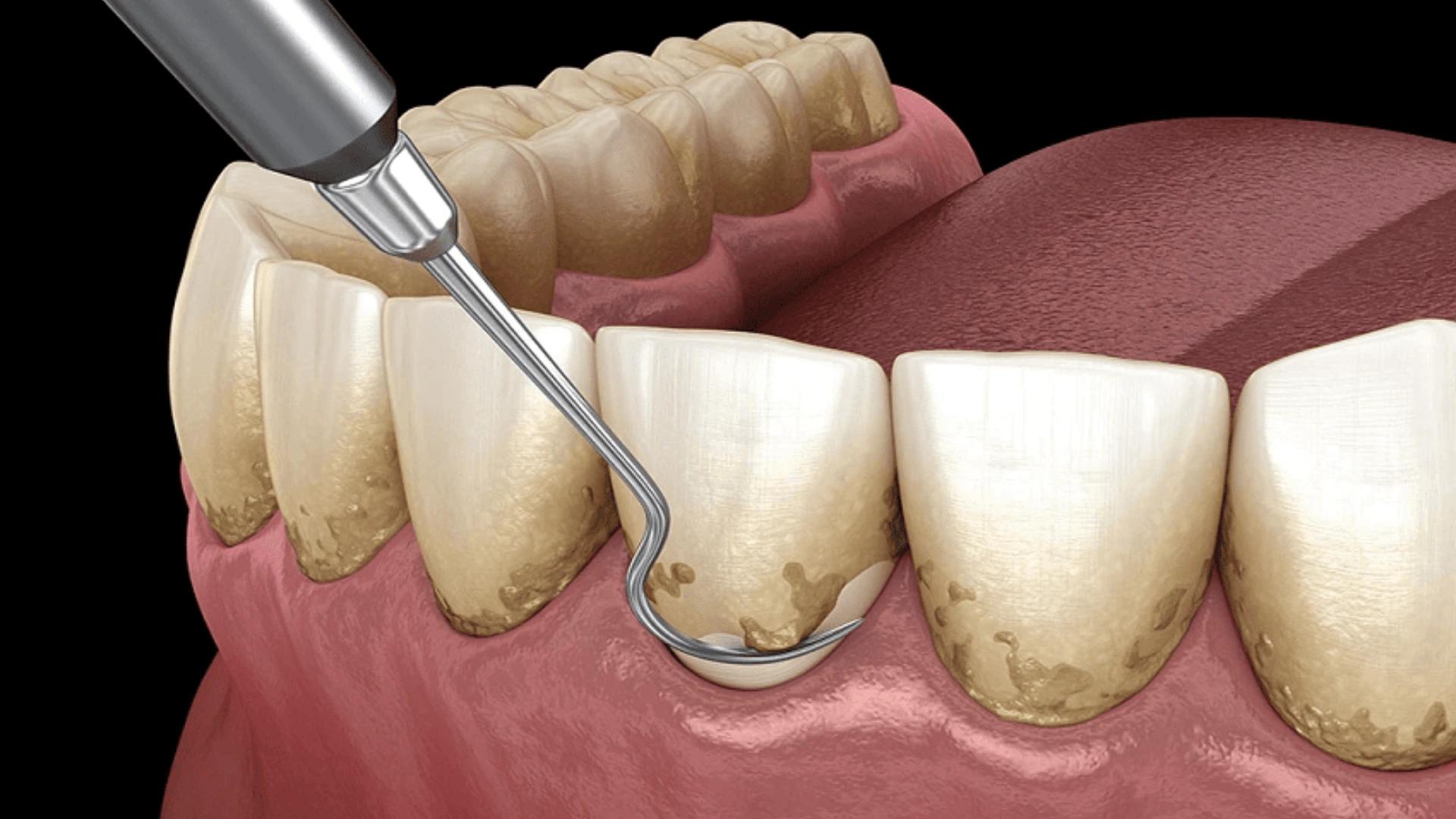 Gum Scaling: An Effective Solution for Treating Gum Diseases