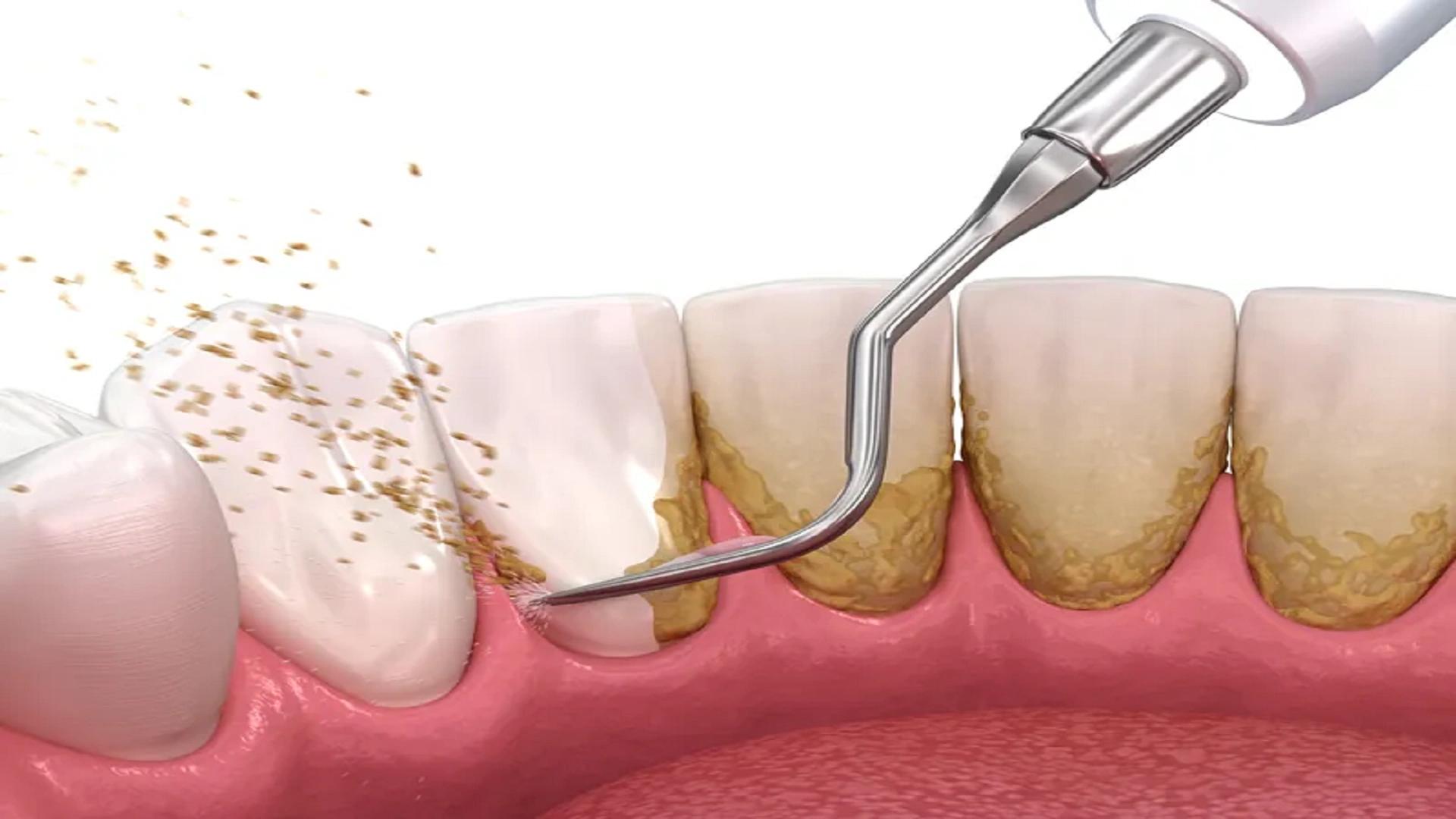 Dental Scaling