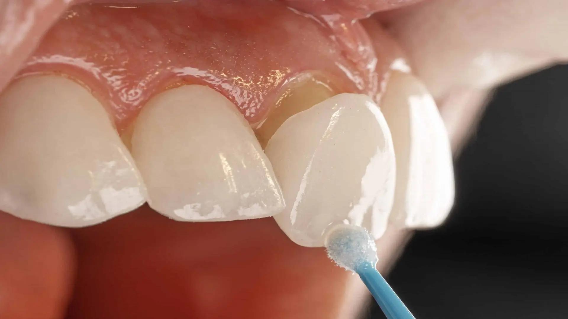 The difference between laminate and dental composite