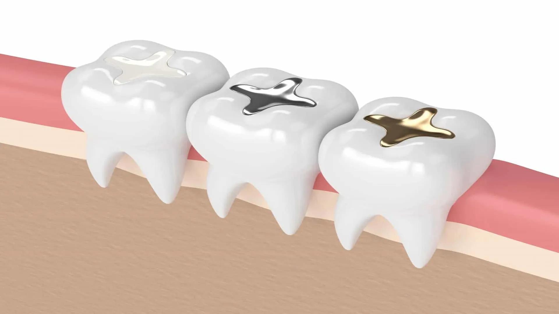 Post-Filling Care: Add More Than 10 Years to Your Tooth's Lifespan!