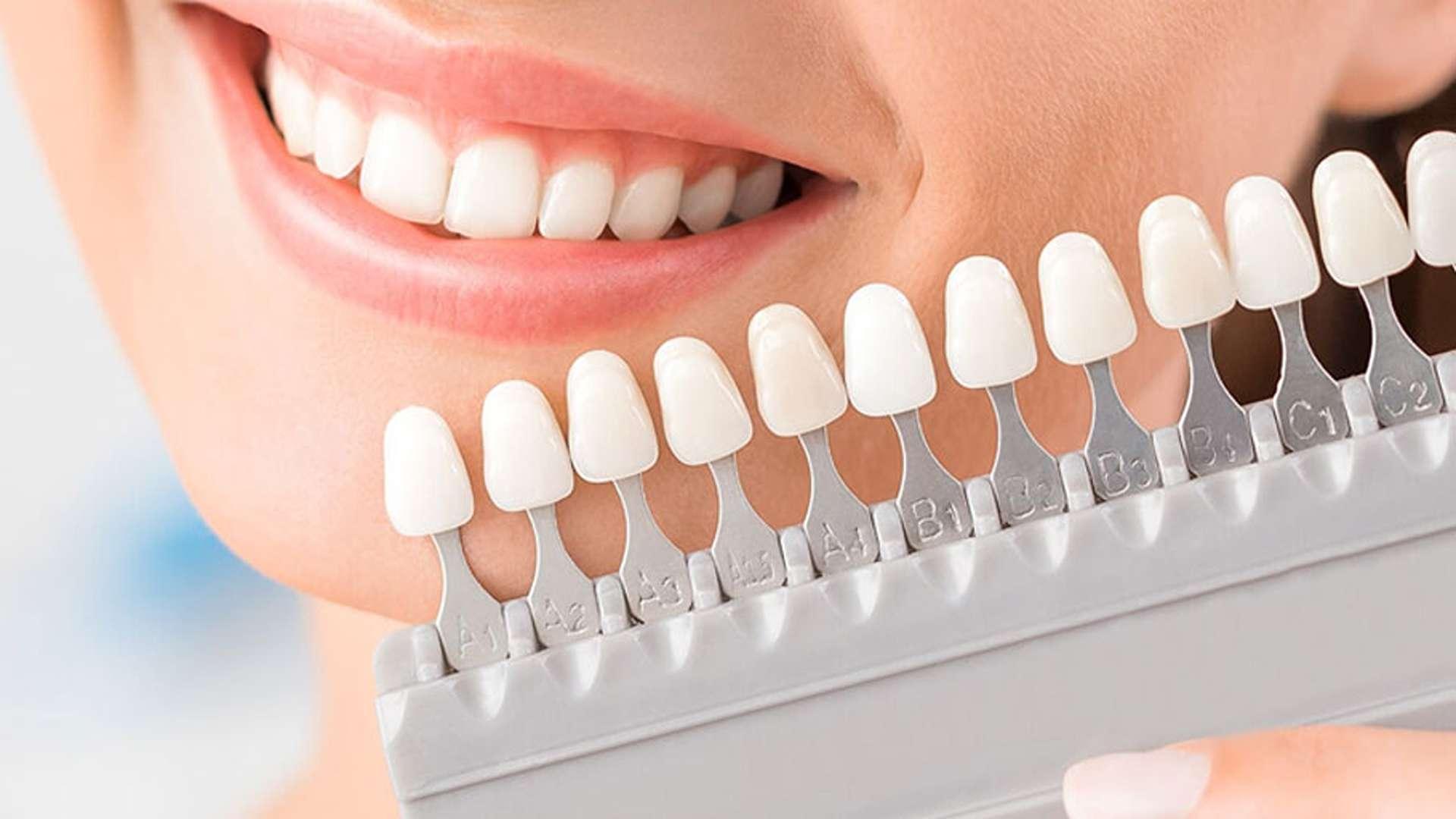 همه چیز درمورد تراش دندان برای لمینت