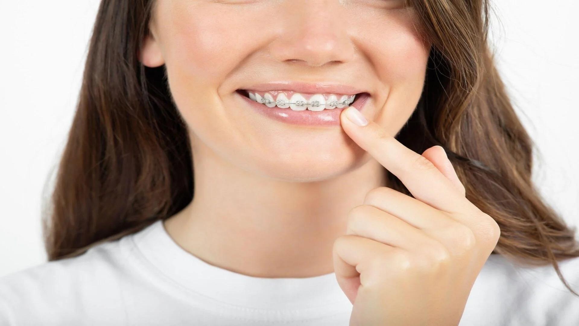 همه چیز درباره صاف و مرتب کردن دندان بدون ارتودنسی + مزایا و معایب