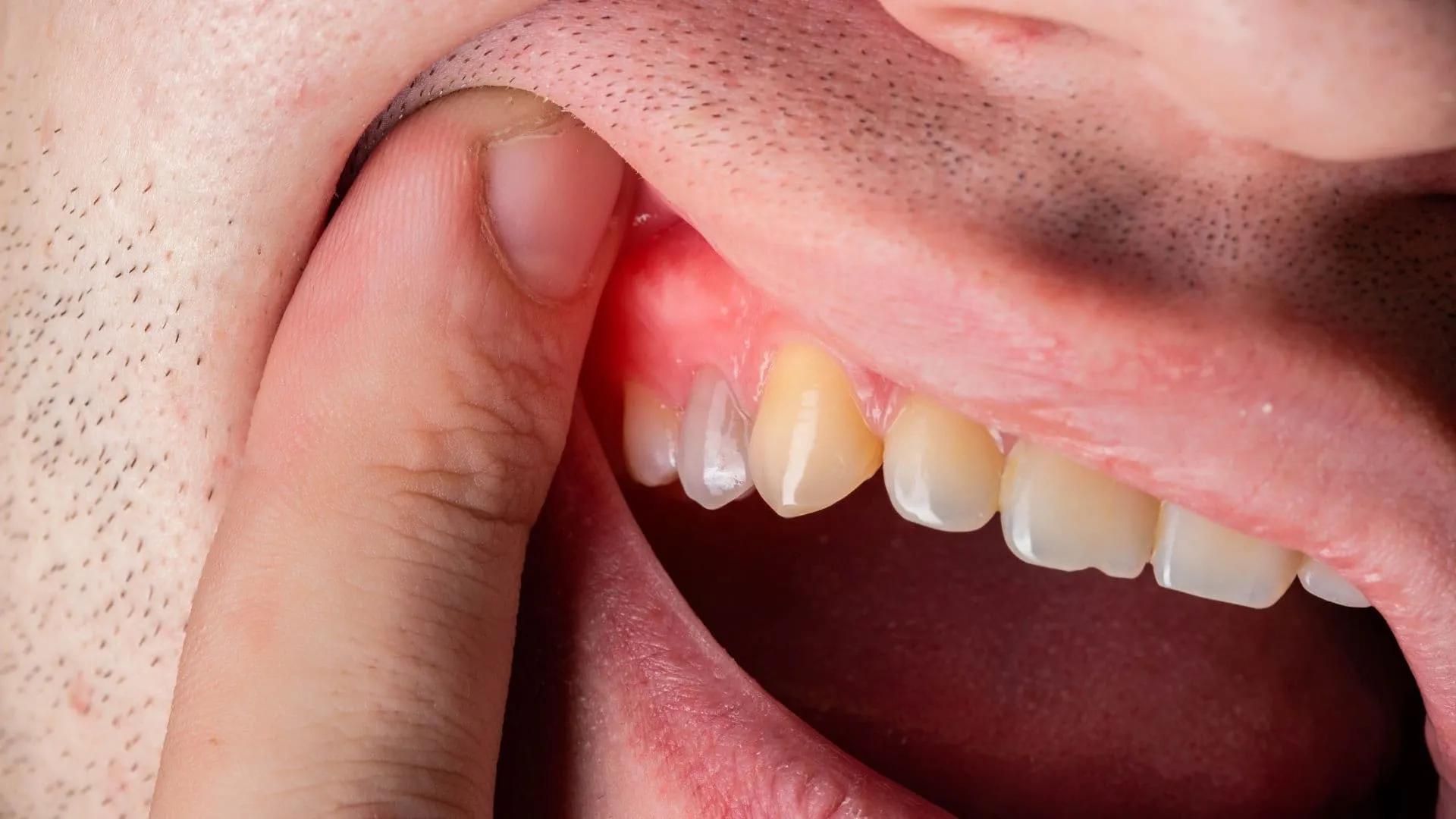 Swollen Gums: Causes, Medical Treatments, and Home Remedies