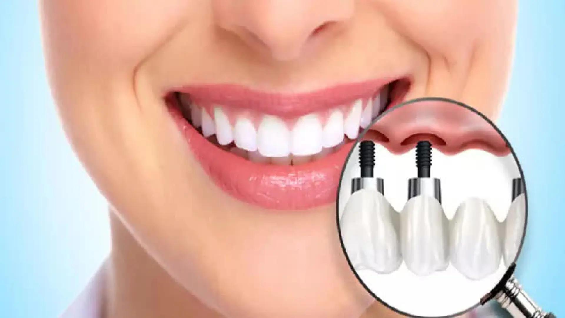 A Complete Introduction to Different Types of Dental Implants (Implant Procedure, Brands, Material, etc.)