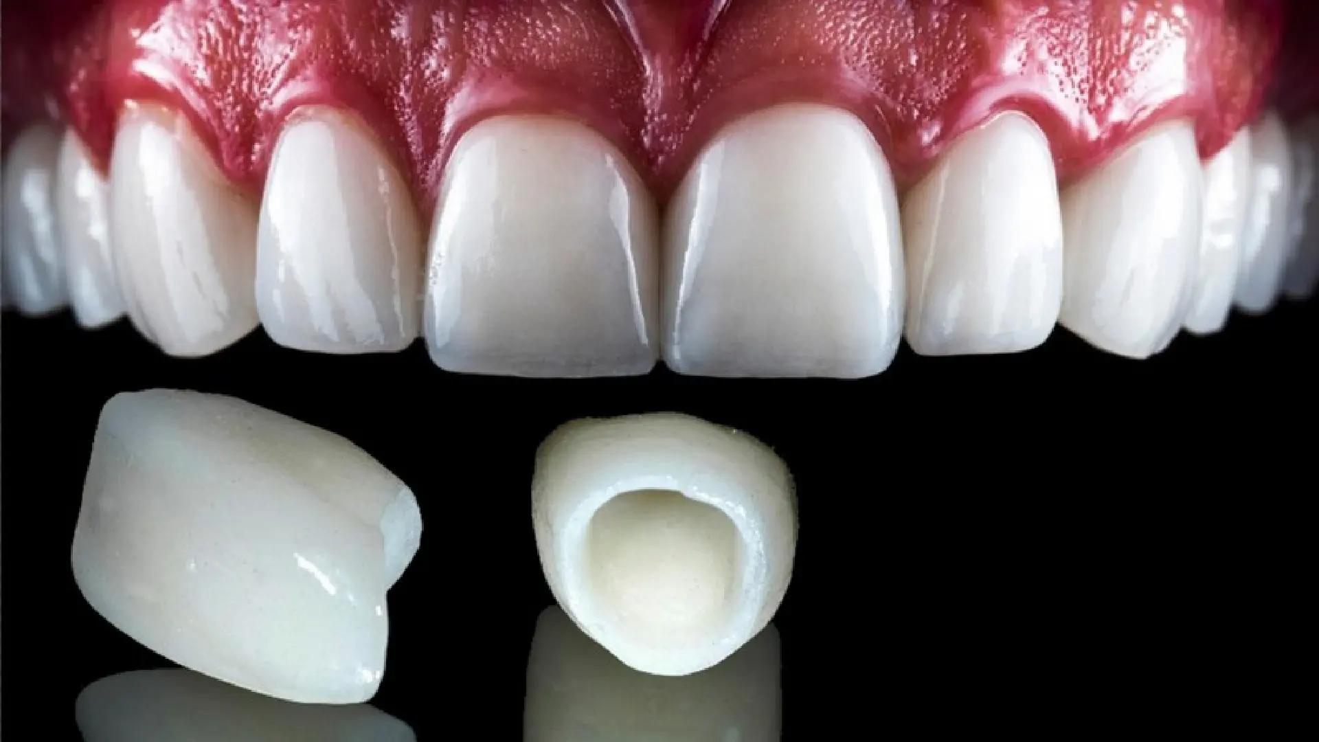 How to Take Care of a Dental Crown? + A Complete Guide to Everything You Need to Know!
