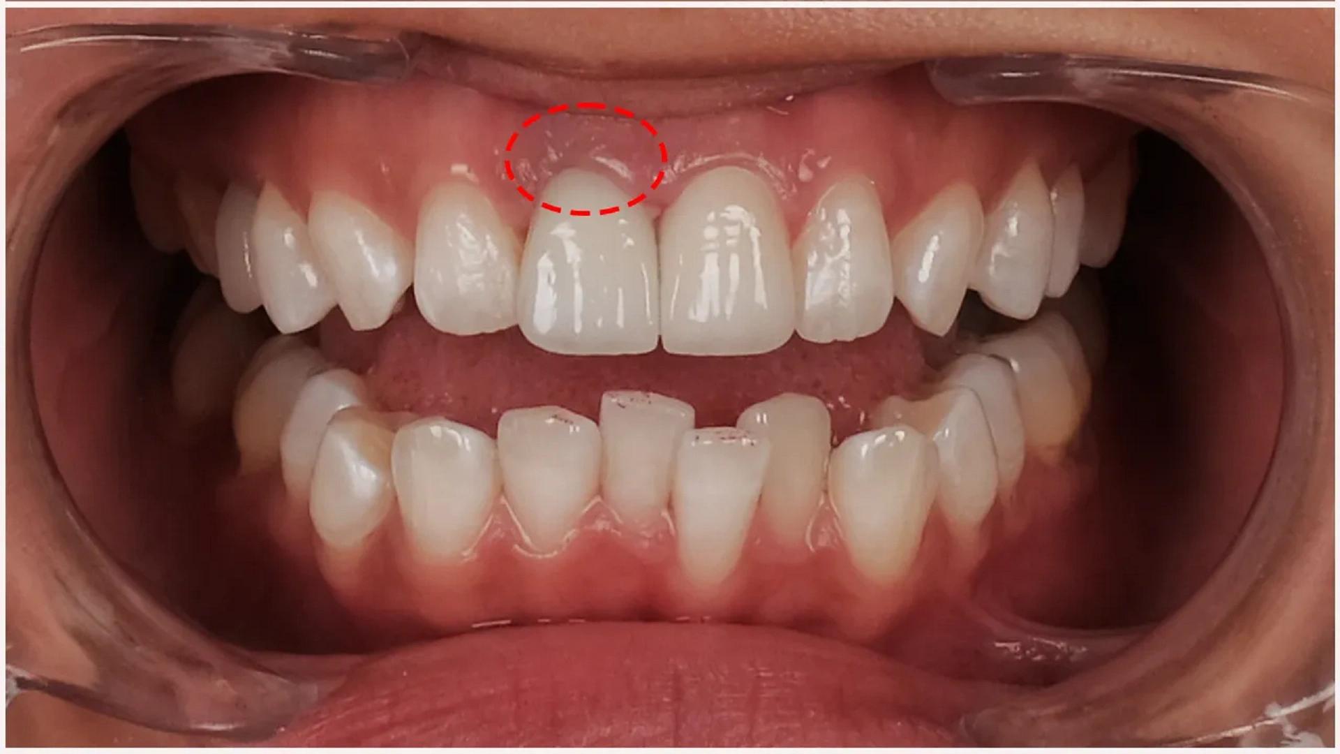 What Are the Side Effects of Dental Veneers? Prevention and Care Methods