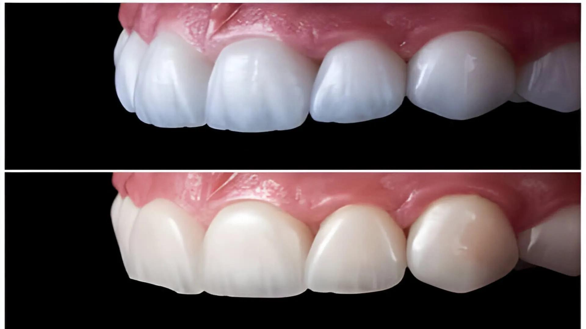What Is the Difference Between Zirconia Crowns and Composite Crowns?
