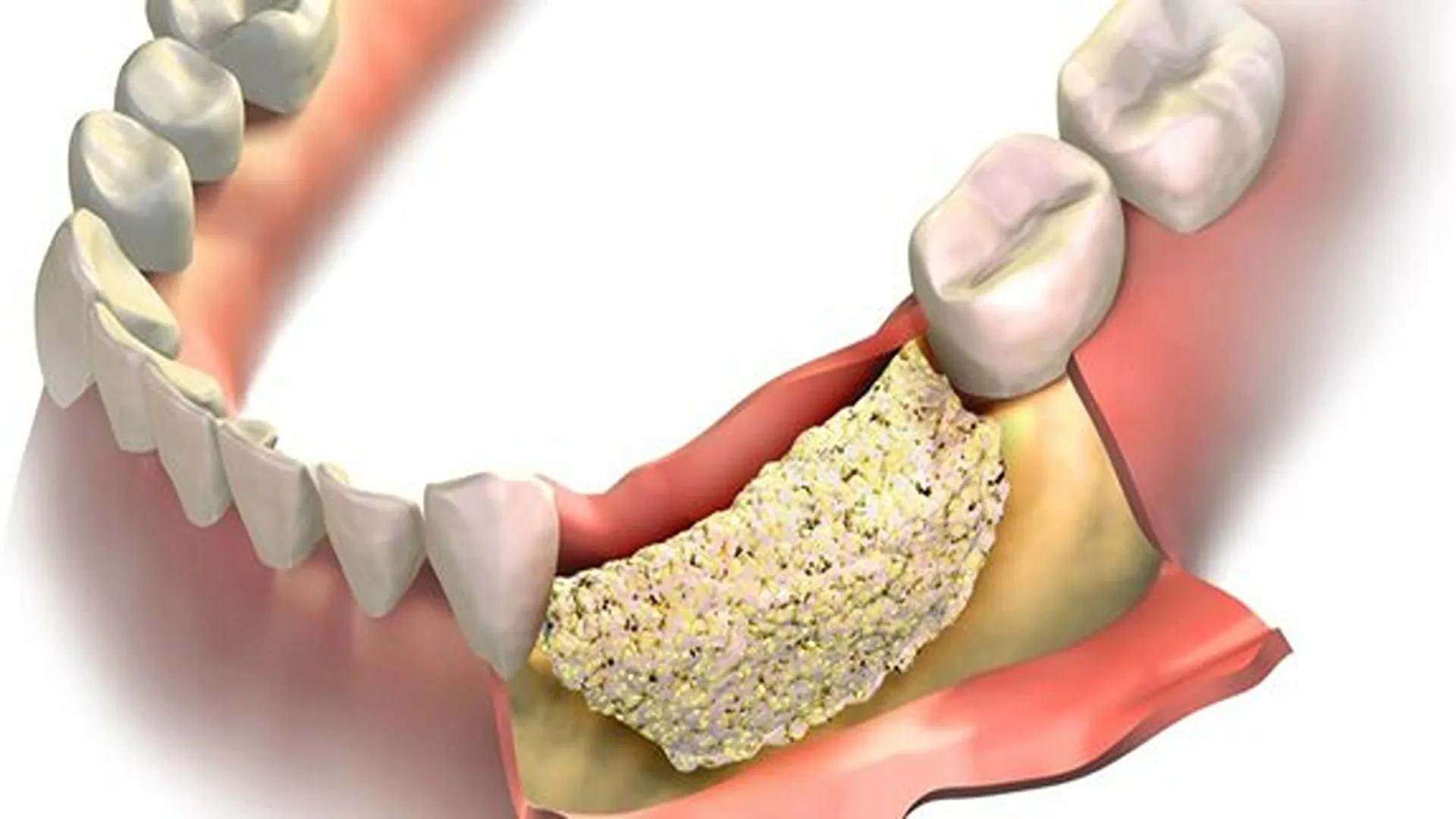 Gum Bone After Tooth Extraction: How to Prevent Gum Recession