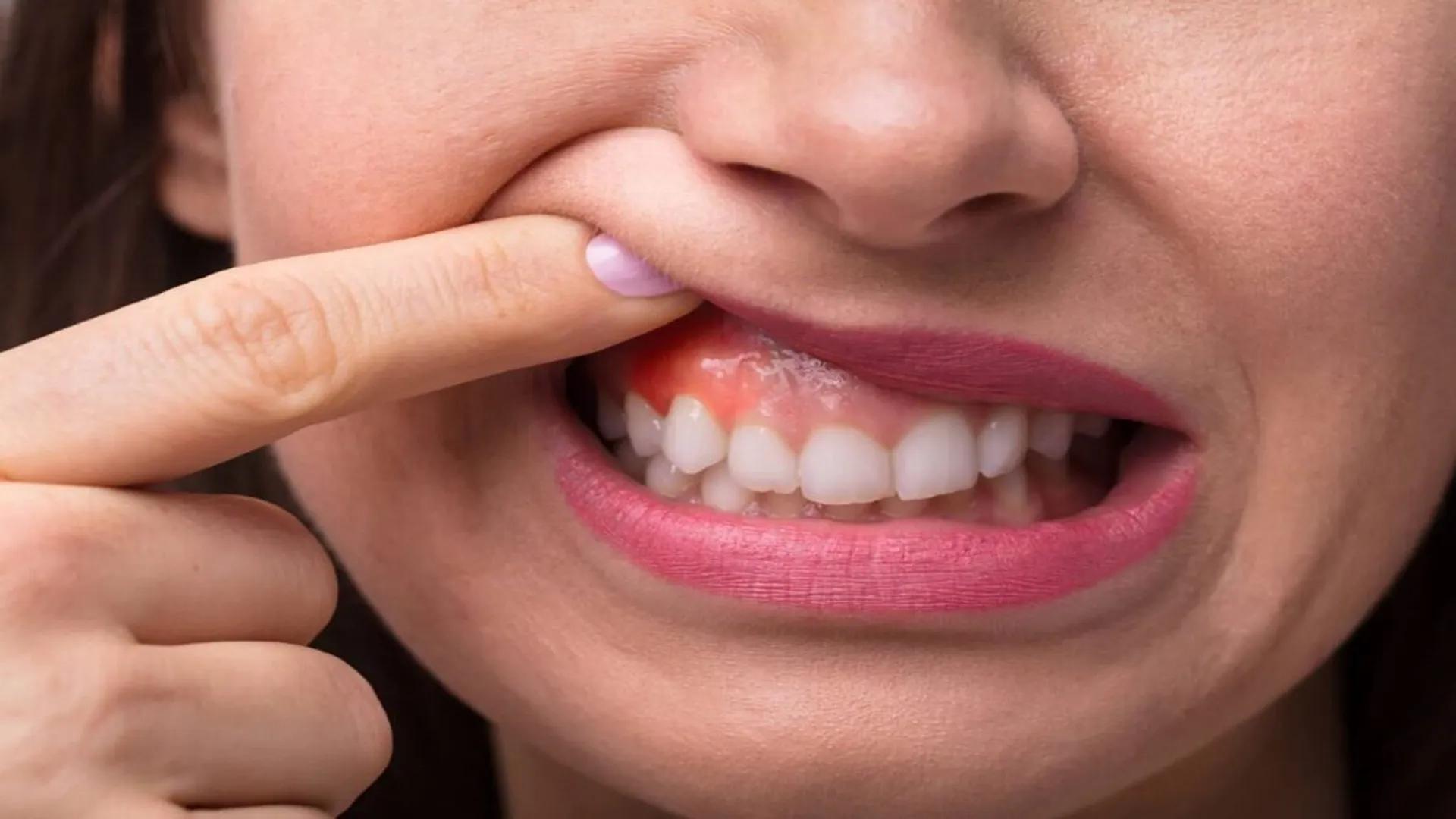 Facial Swelling Due to Toothache in Traditional Medicine