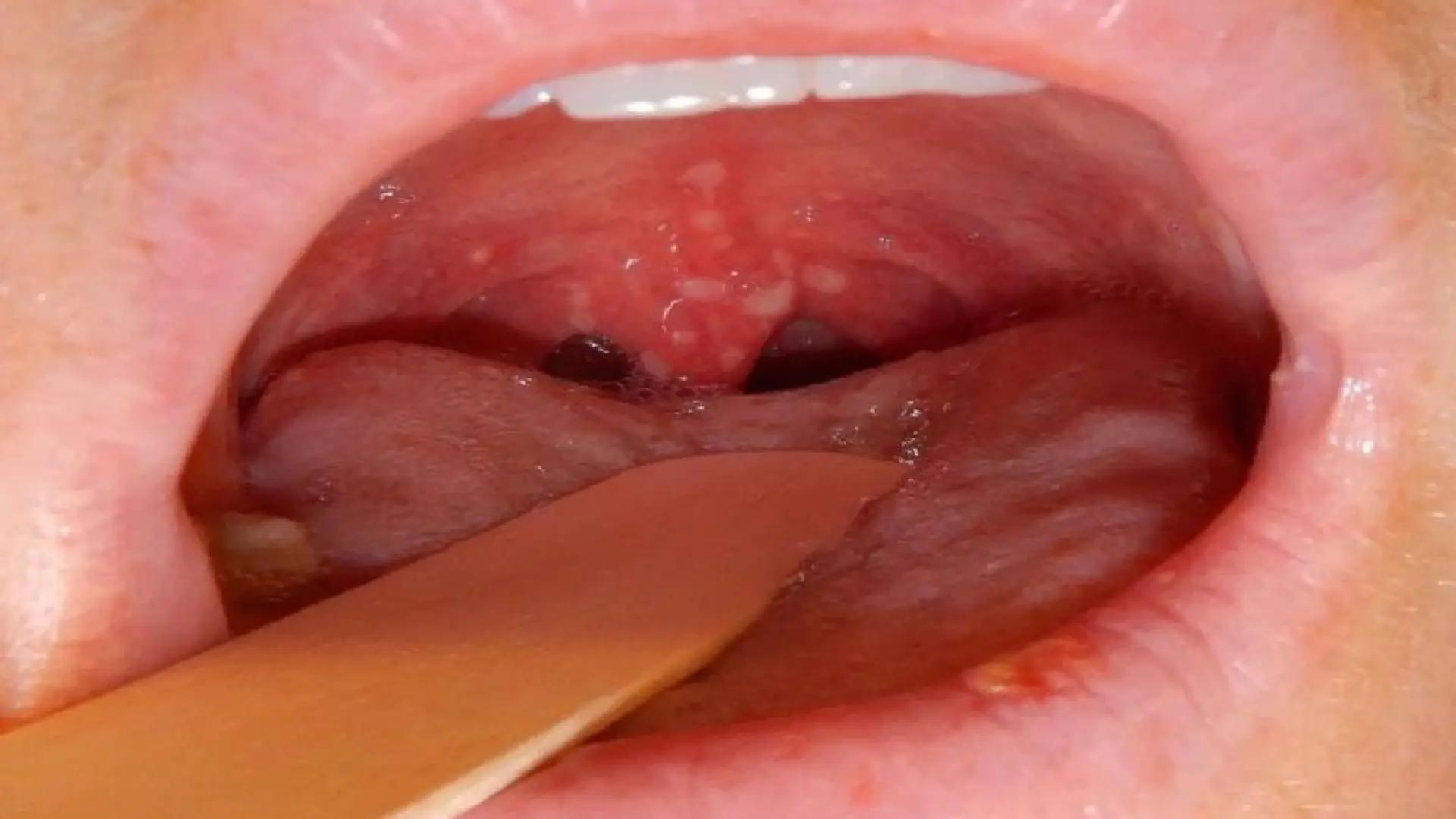 Introduction to Oral Warts + The Most Complete Information About This Condition and Its Treatment