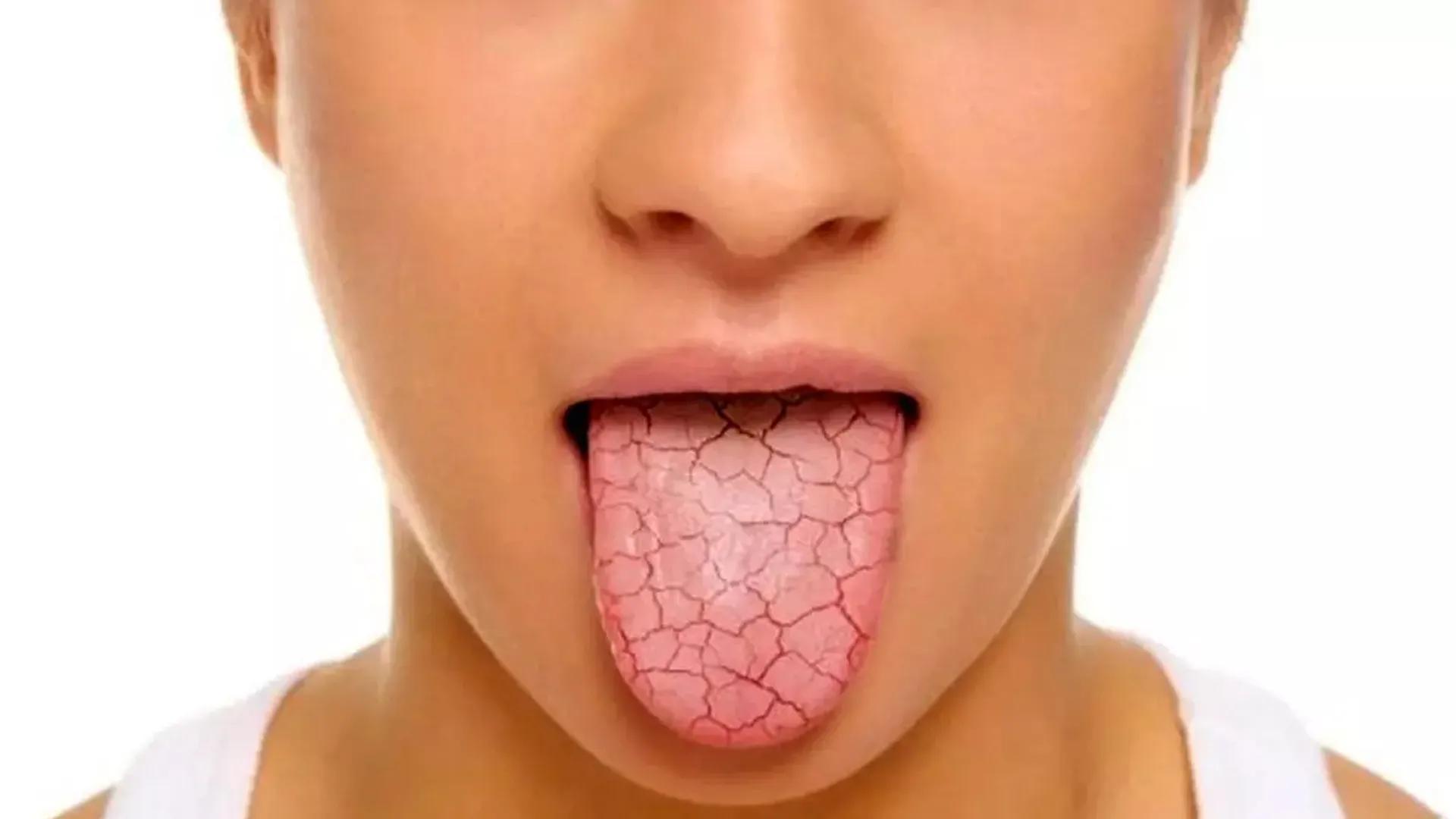 What Causes Dry Mouth? Which Diseases Lead to Dry Mouth?