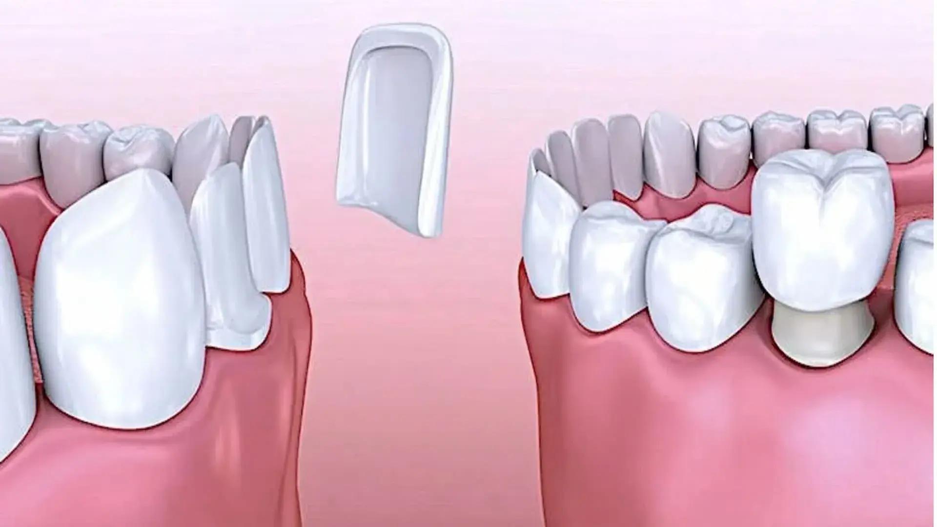 تفاوت روکش دندان زیرکونیا با لمینت دندان چیست؟