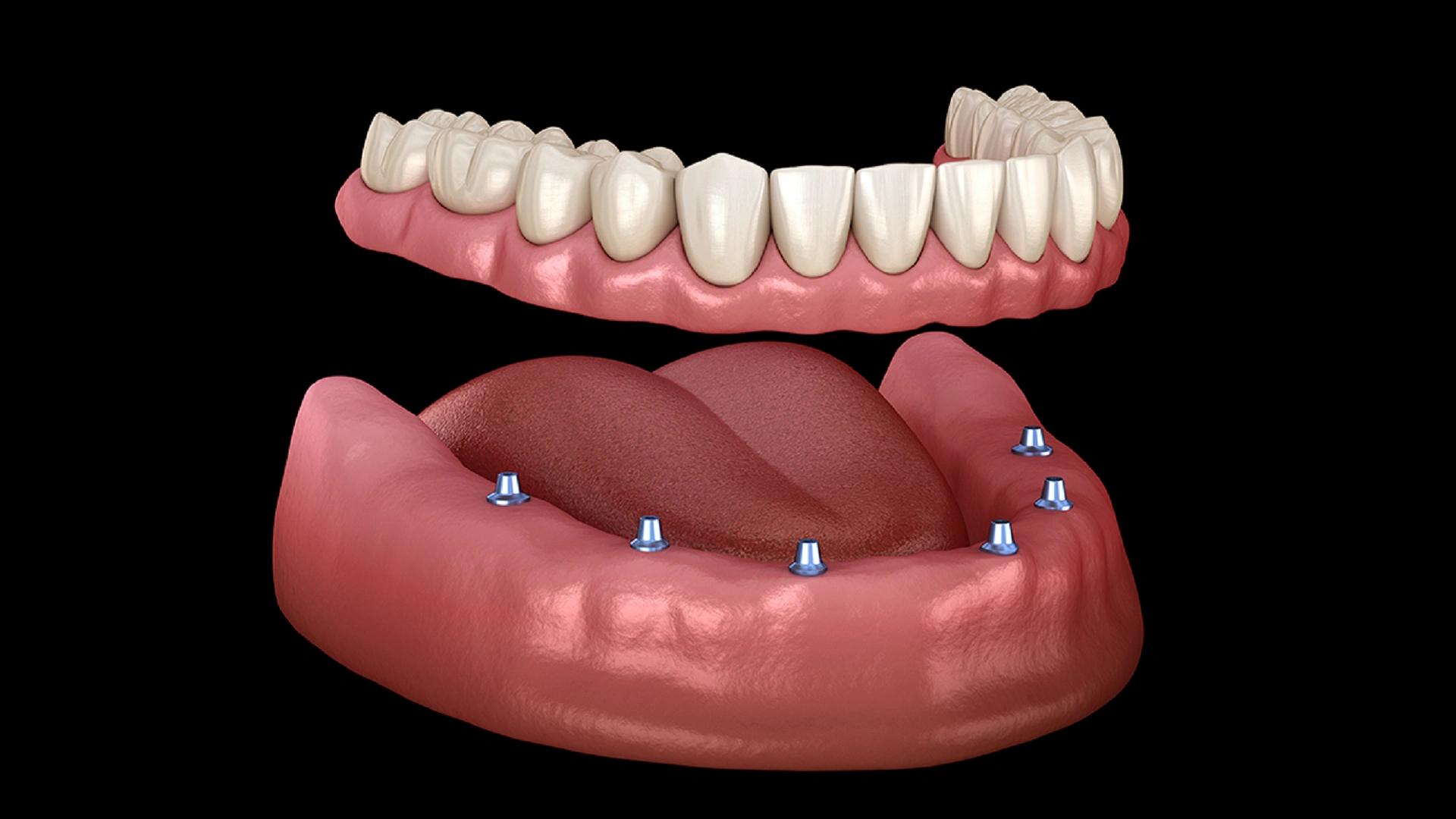 What is an Overdenture? A Comprehensive Guide from Procedure to Care