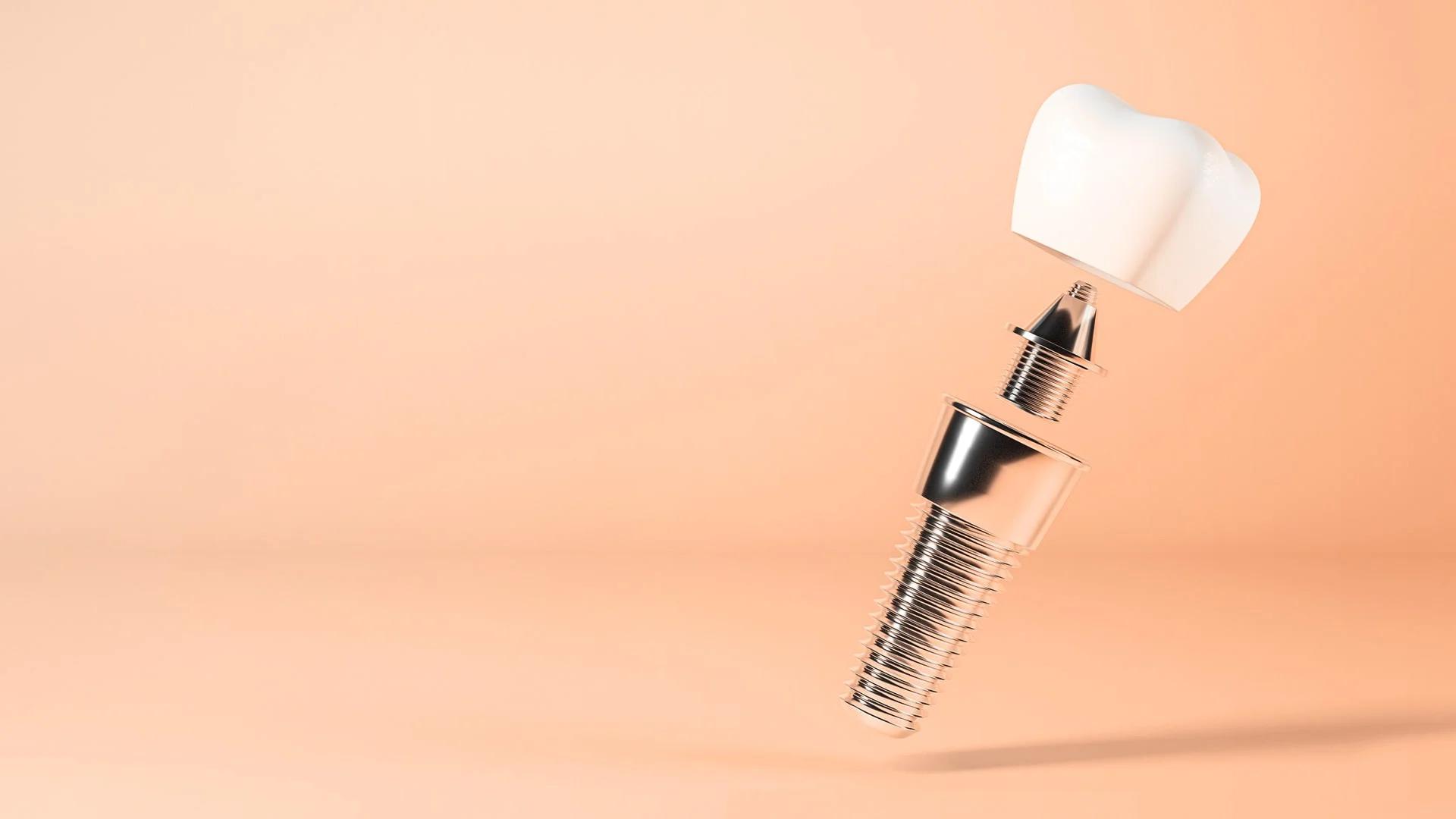 Dental Implant Fixture: A Guide to Choosing the Implant Base and Understanding Why It Falls Out