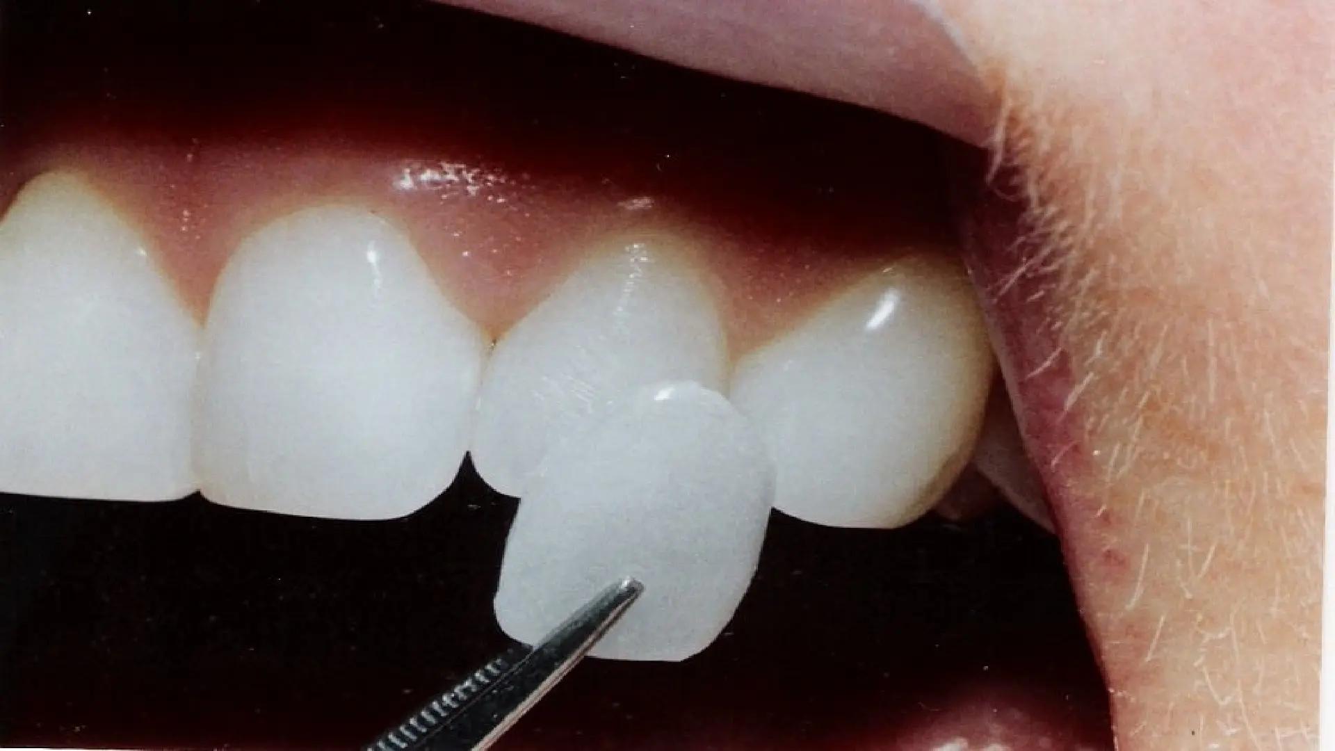Complete Introduction to Different Types of Dental Veneers + Procedure Steps