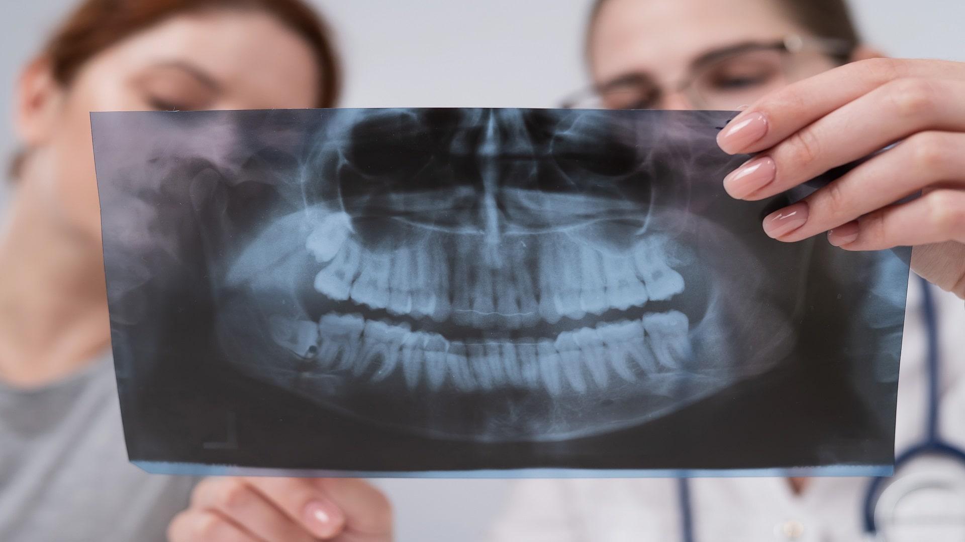 Causes of Tooth Loosening After Root Canal Treatment