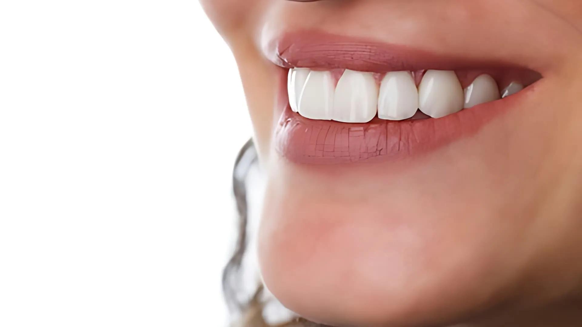 Dental laminate