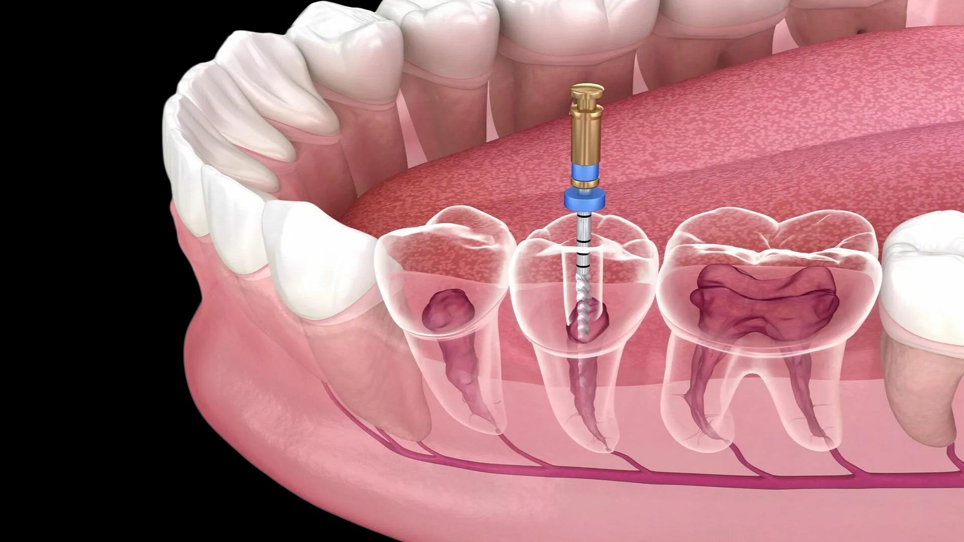 Investigating the Cause of Tooth Pain After Root Canal Treatment: Why Does Tooth Pain Persist After a Root Canal?