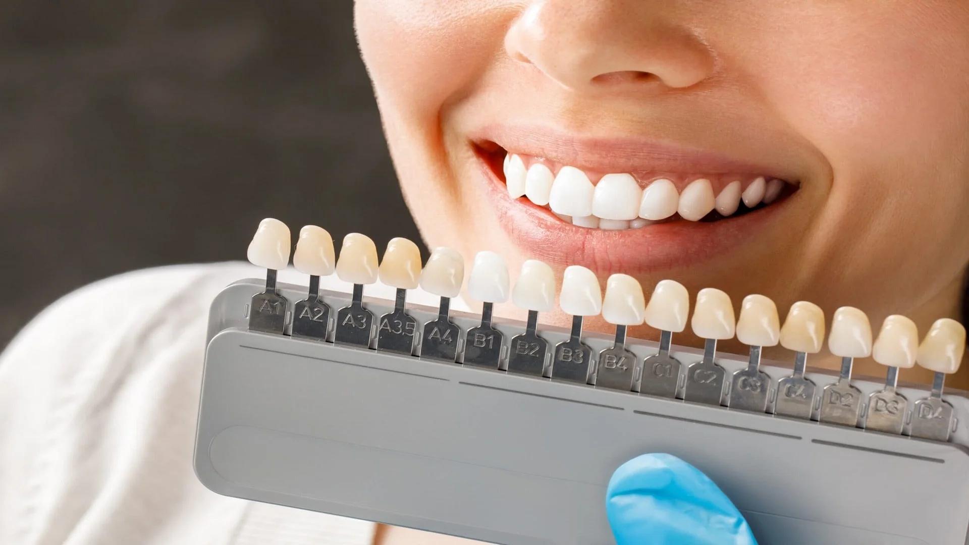 How Many Teeth Does Each Laminate Unit Cover? A Guide for Better Decision-Making