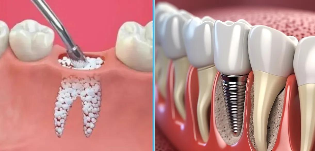 Bone graft surgery