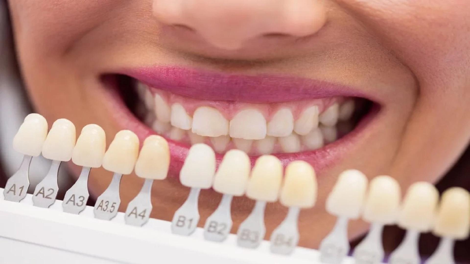 Post-Composite Dental Care for Increasing the Longevity of Dental Composites