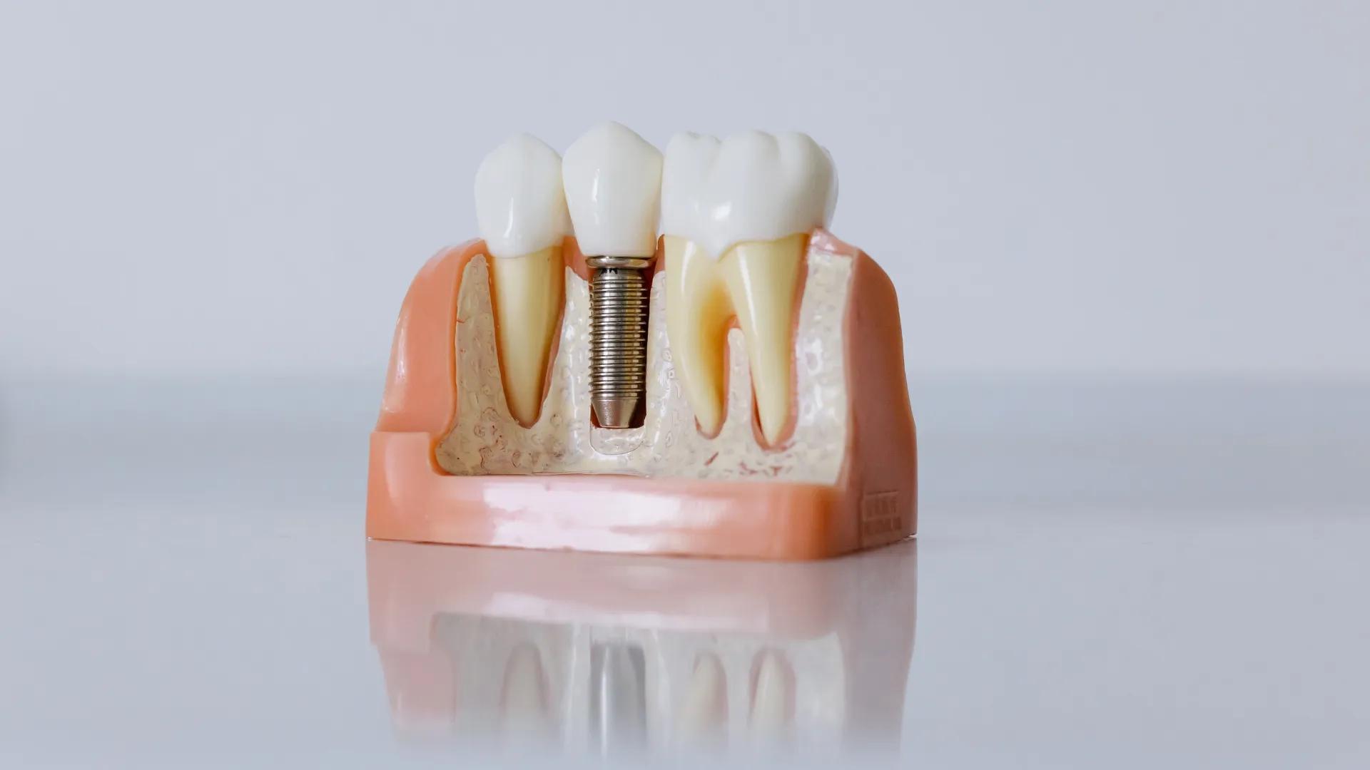 How Many Steps Are Involved in Implant Impression Taking? A to Z of Implant Impression Taking