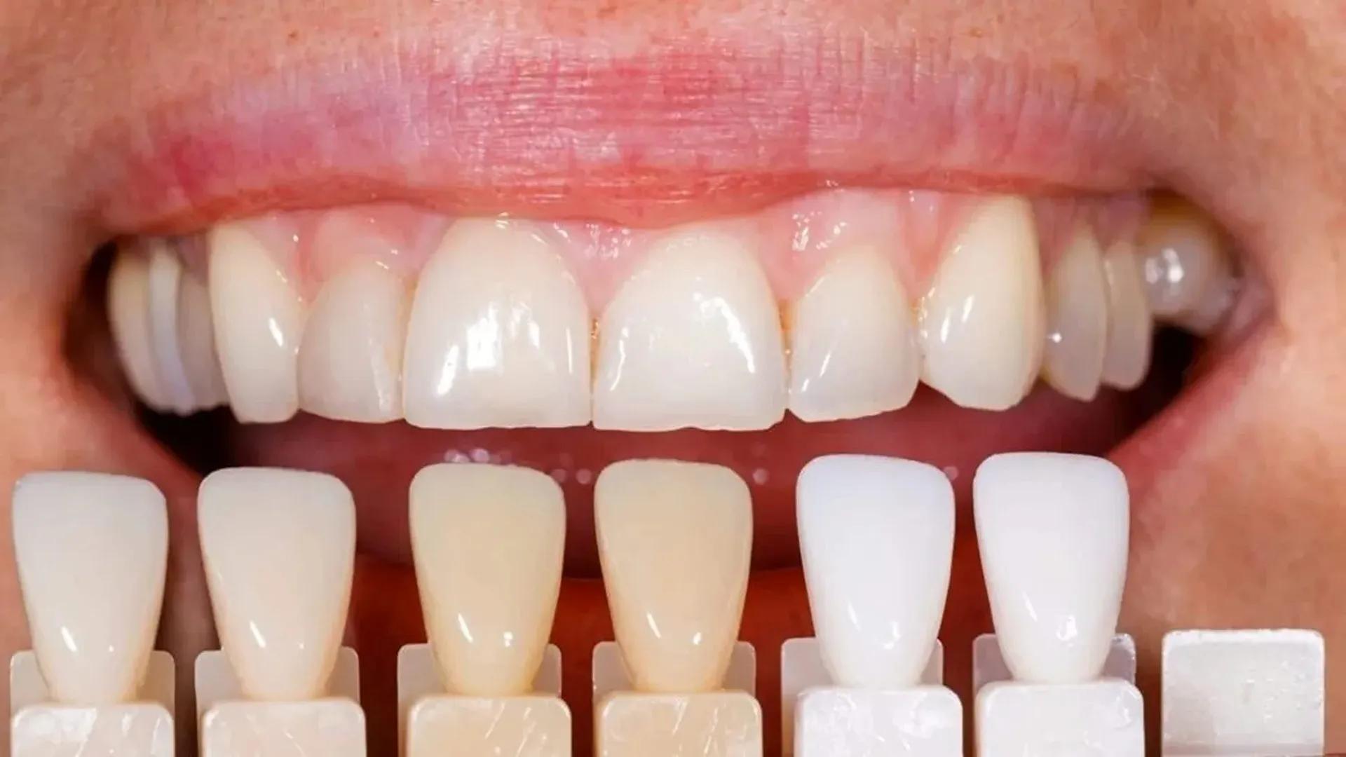 Rabbit Teeth Composite + Teeth Correction Without Orthodontics at the Best Price
