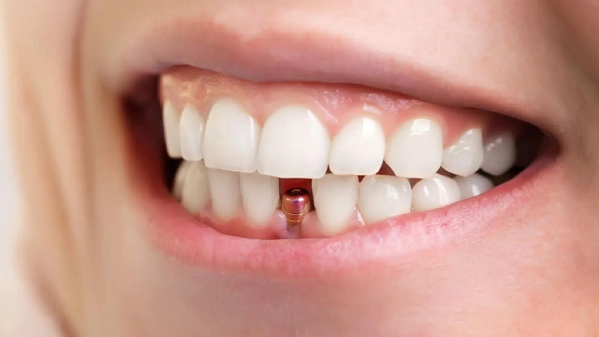 Post-Implant Care: Accelerating Healing and Gum Inflammation After Dental Implants