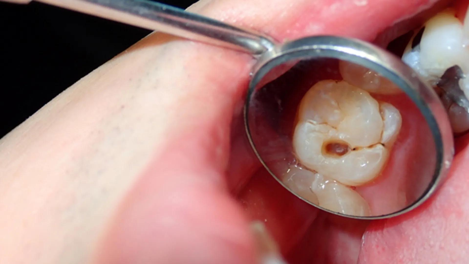 Everything You Need to Know About What to Eat After a Root Canal