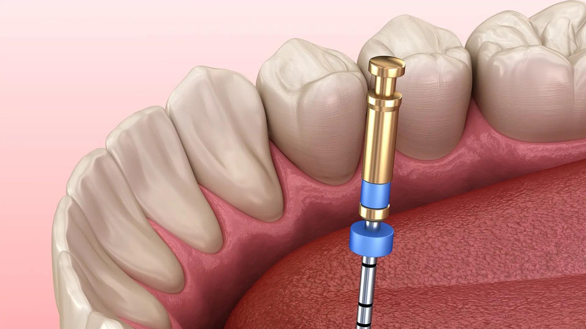 Root Canal Treatment