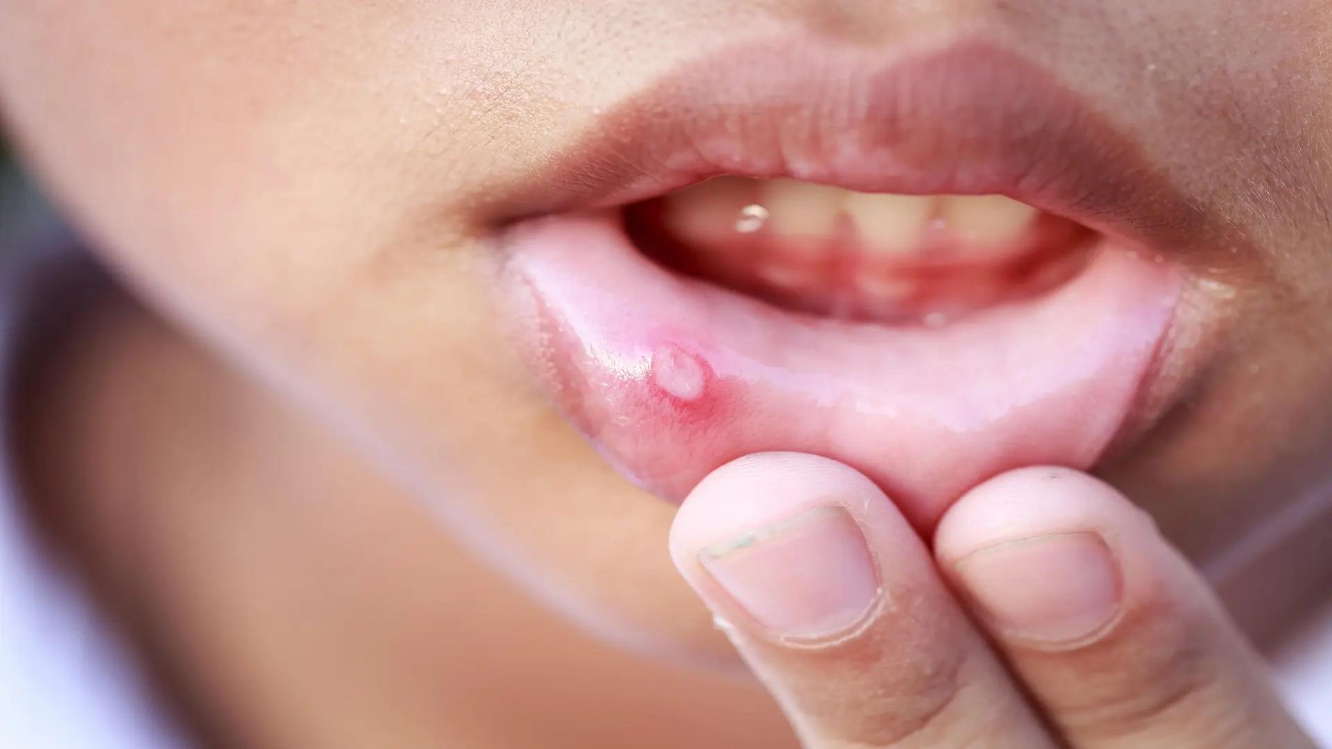 Fast treatment of canker sores